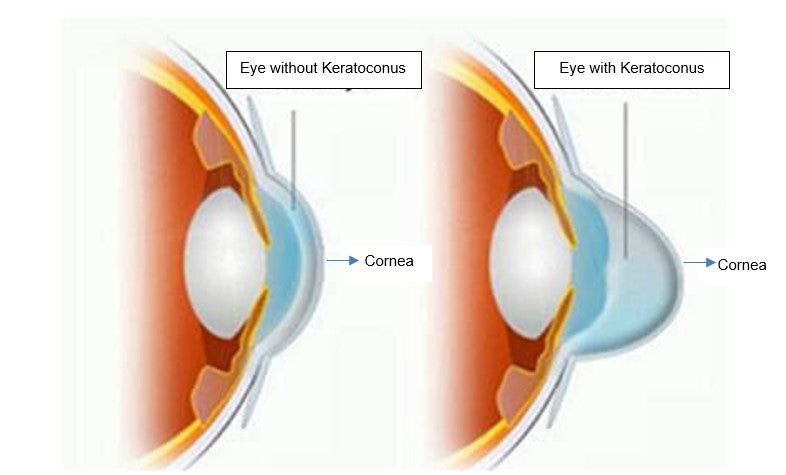 MCT technology orthokeratology lens for subclinical keratoconus
