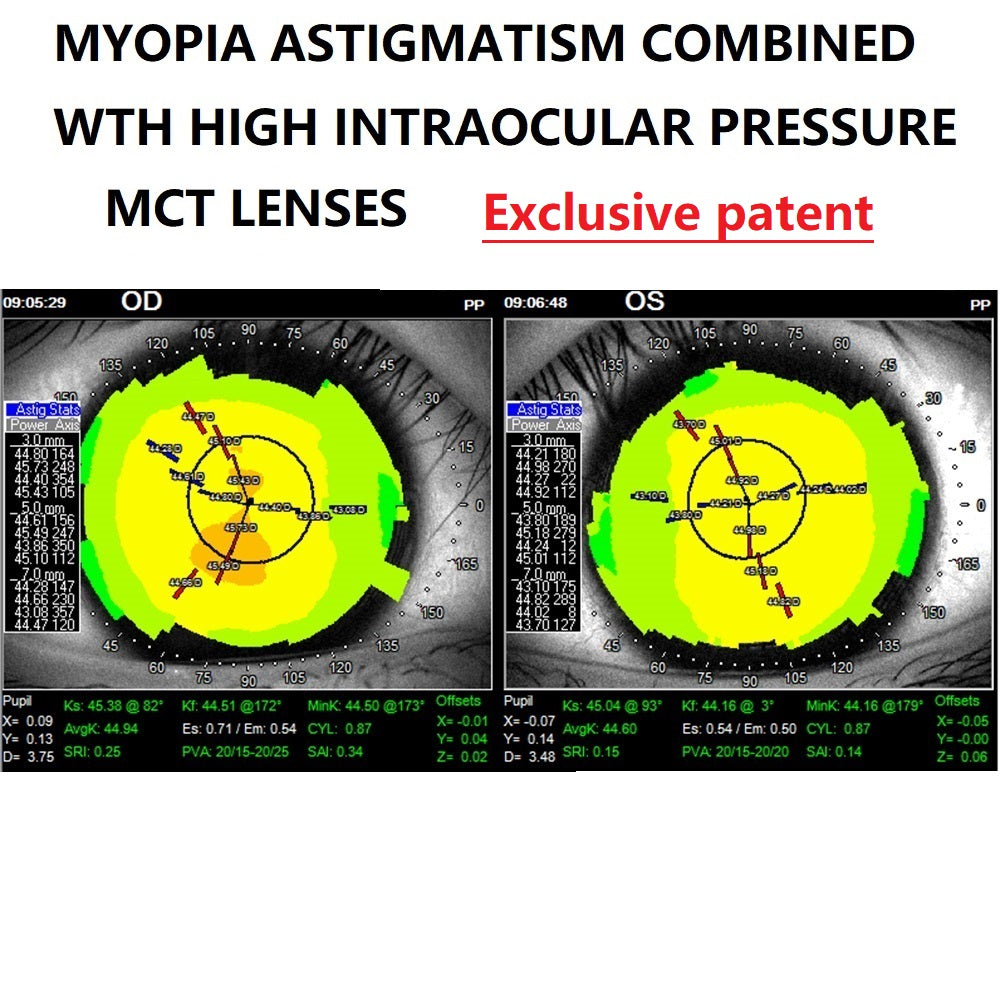 MCT technology ortho-k lens for myopic astigmatism combined with high intraocular pressure