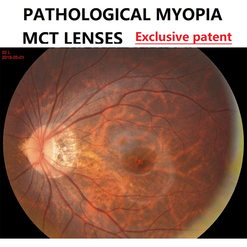 MCT Technology Orthokeratology Lens For The Treatment Of Pathological Myopia