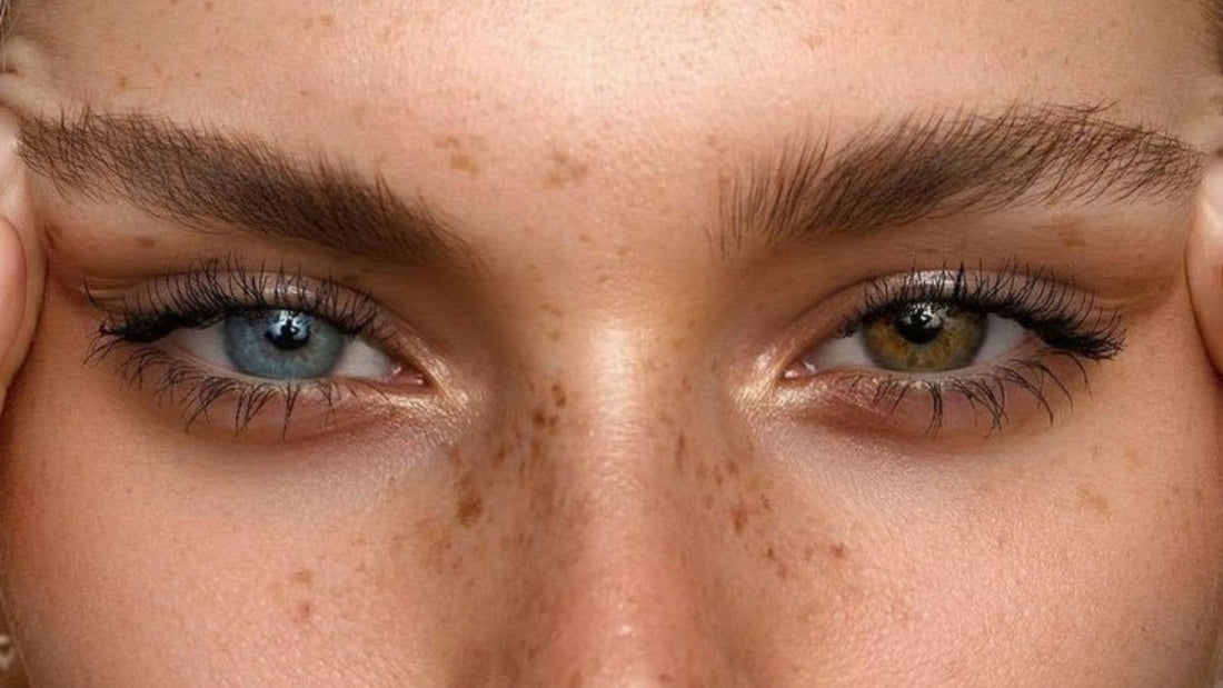 What Is Heterochromia?