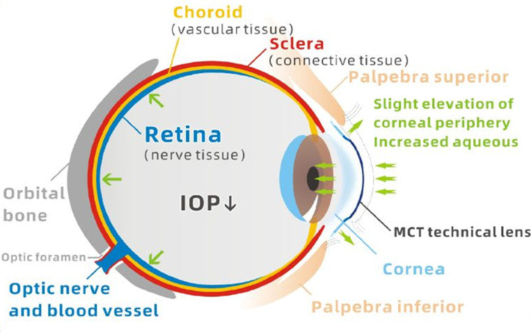 MCT Technology Orthokeratology Lens For The Treatment Of Pathological Myopia