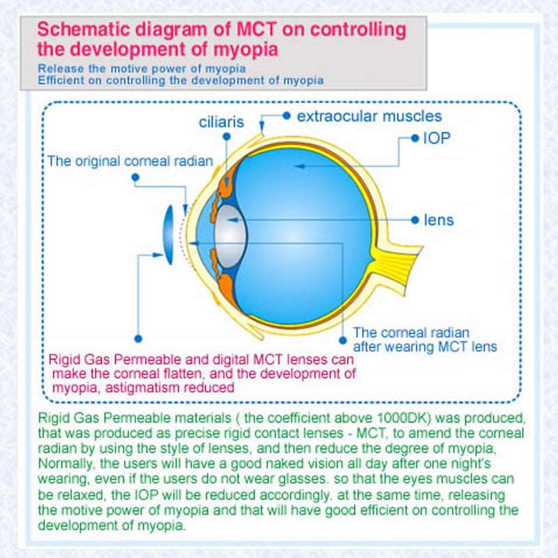 MCT technology orthokeratology lenses for various myopia