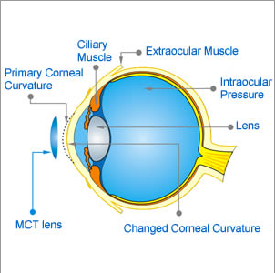 MCT technology orthokeratology lens for myopic astigmatism combined with high intraocular pressure