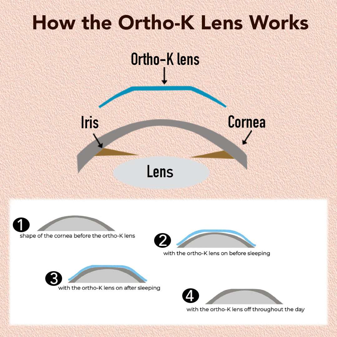 MCT Technology Orthokeratology Lens For The Treatment Of Pathological Myopia