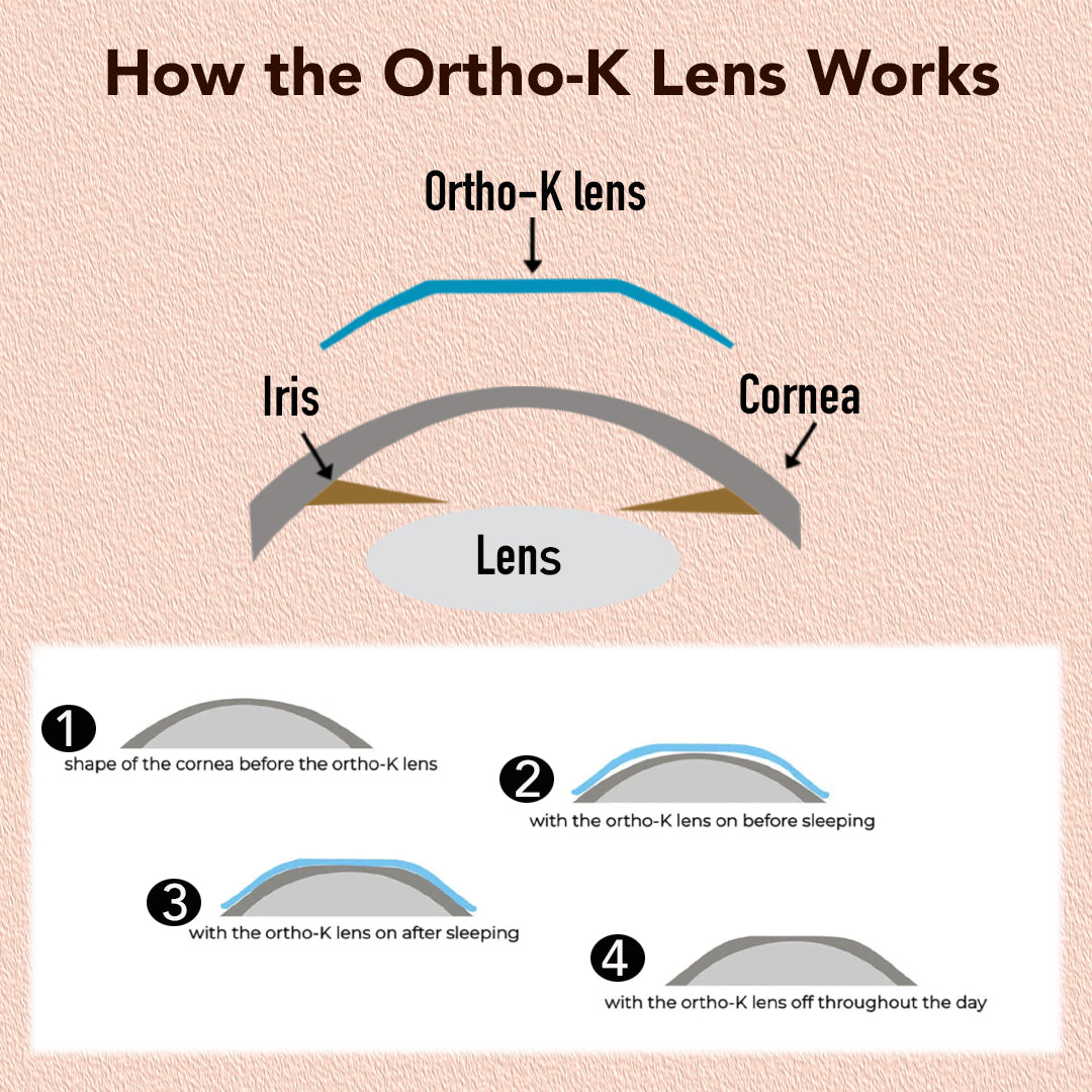 MCT technology orthokeratology lenses for various myopia