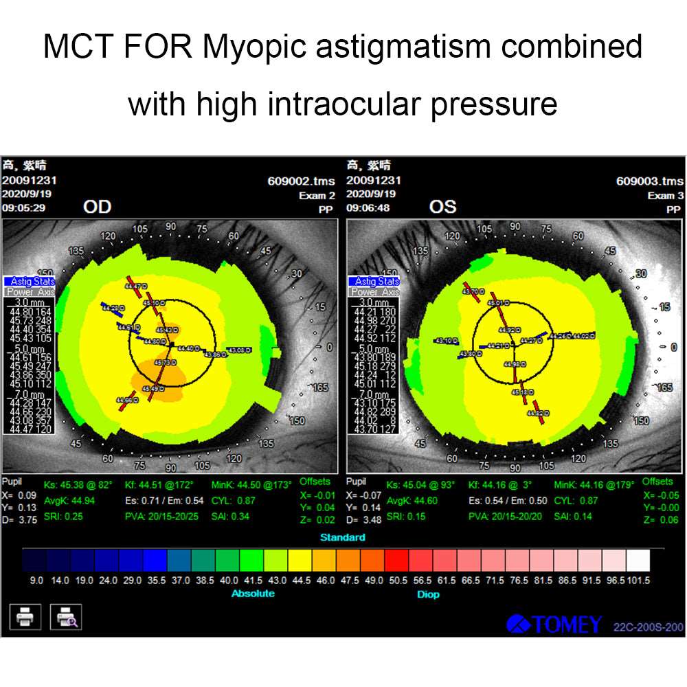 MCT technology orthokeratology lens for myopic astigmatism combined with high intraocular pressure