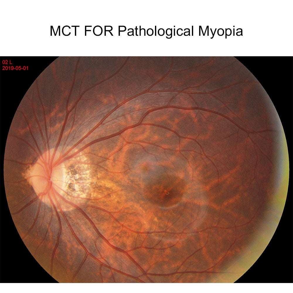 MCT Technology Orthokeratology Lens For The Treatment Of Pathological Myopia