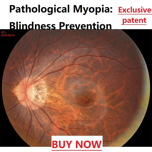 MCT Technology Orthokeratology Lens For The Treatment Of Pathological Myopia