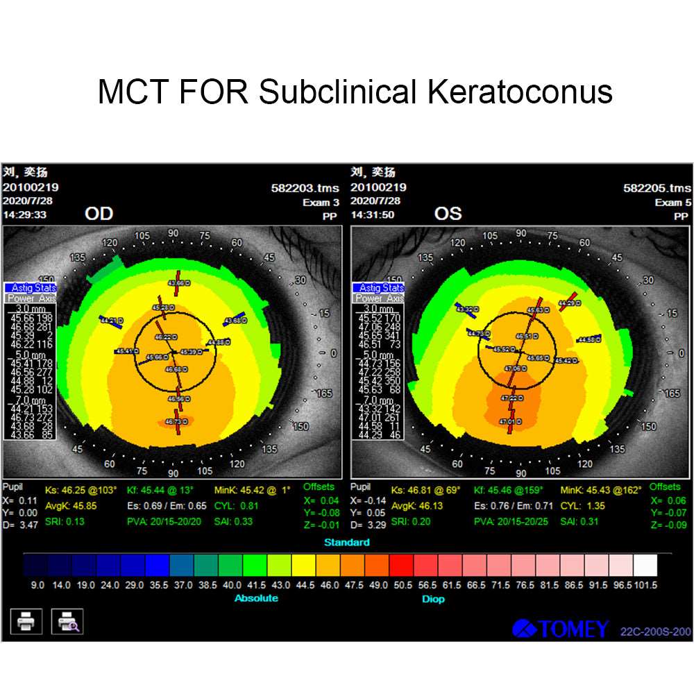 MCT technology orthokeratology lens for subclinical keratoconus