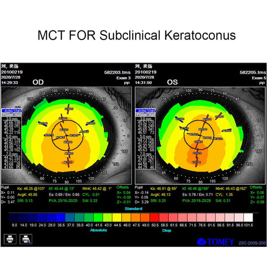 MCT technology orthokeratology lens for subclinical keratoconus