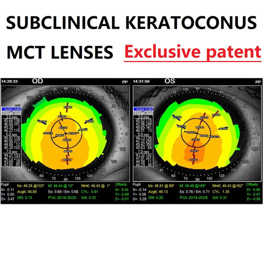 MCT technology orthokeratology lens for subclinical keratoconus